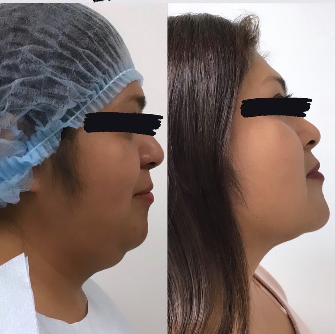 A man and woman with plastic surgery on their faces.