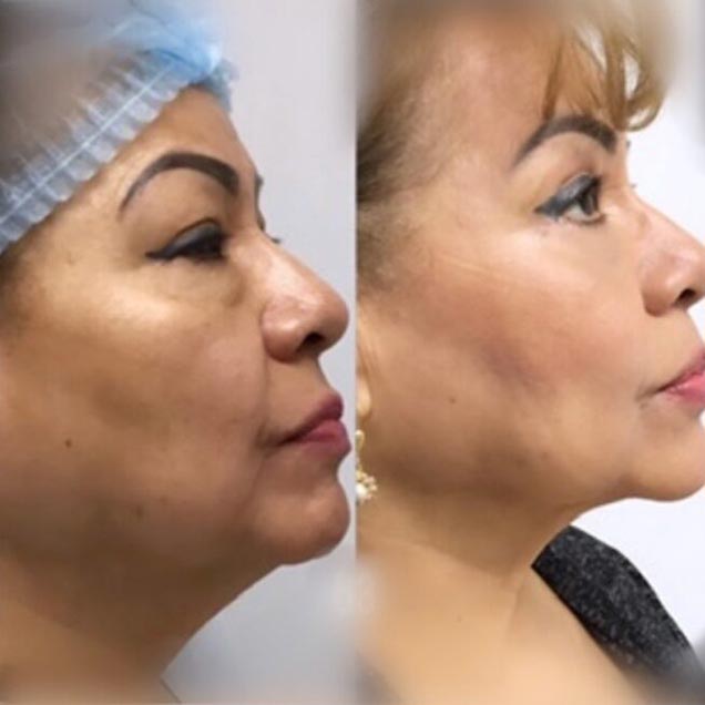 Before and After at Face Works Plastic Surgery, Plastic Surgeon in Schaumburg, IL Before and After at Face Works Plastic Surgery, Plastic Surgeon in Schaumburg, IL