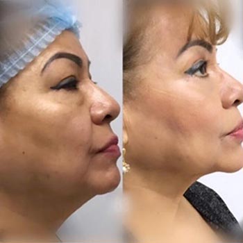 Before and After at Face Works Plastic Surgery, Plastic Surgeon in Schaumburg, IL Before and After at Face Works Plastic Surgery, Plastic Surgeon in Schaumburg, IL