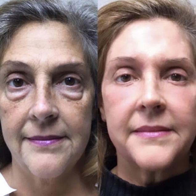 Before and After at Face Works Plastic Surgery, Plastic Surgeon in Schaumburg, IL Before and After at Face Works Plastic Surgery, Plastic Surgeon in Schaumburg, IL