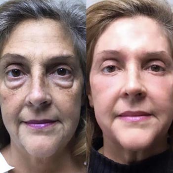 Before and After at Face Works Plastic Surgery, Plastic Surgeon in Schaumburg, IL Before and After at Face Works Plastic Surgery, Plastic Surgeon in Schaumburg, IL
