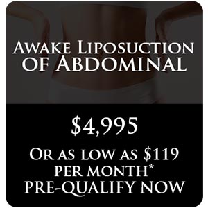 Awake Liposuction of Abdominal
