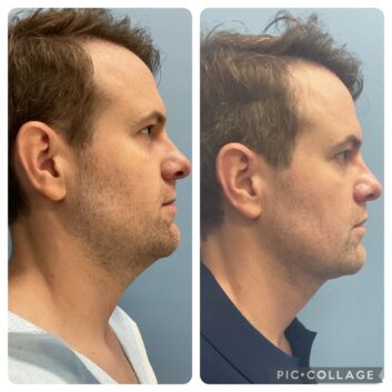 HD LipoX® of Jawline at Face Works Plastic Surgery, Plastic Surgeon Near Me in Schaumburg, IL HD LipoX® of Jawline at Face Works Plastic Surgery, Plastic Surgeon Near Me in Schaumburg, IL