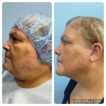 HD LipoX® of Jawline at Face Works Plastic Surgery, Plastic Surgeon Near Me in Schaumburg, IL