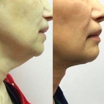 HD LipoX® of Jawline at Face Works Plastic Surgery, Plastic Surgeon Near Me in Schaumburg, IL