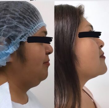 HD LipoX® of Jawline at Face Works Plastic Surgery, Plastic Surgeon Near Me in Schaumburg, IL HD LipoX® of Jawline at Face Works Plastic Surgery, Plastic Surgeon Near Me in Schaumburg, IL