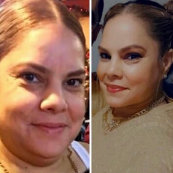 HD LipoX® of Jawline at Face Works Plastic Surgery, Plastic Surgeon Near Me in Schaumburg, IL