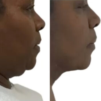 HD LipoX® of Jawline at Face Works Plastic Surgery, Plastic Surgeon Near Me in Schaumburg, IL
