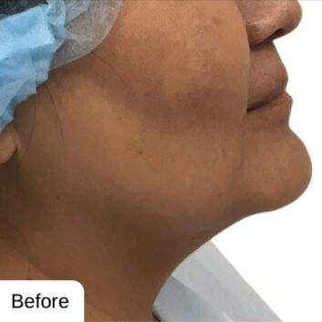 HD LipoX® of Jawline at Face Works Plastic Surgery, Plastic Surgeon Near Me in Schaumburg, IL