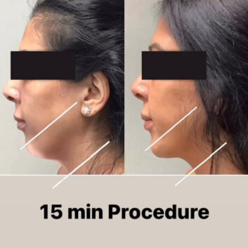 HD LipoX® of Jawline at Face Works Plastic Surgery, Plastic Surgeon Near Me in Schaumburg, IL