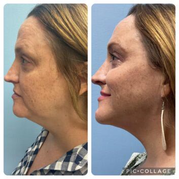 HD LipoX® of Jawline at Face Works Plastic Surgery, Plastic Surgeon Near Me in Schaumburg, IL
