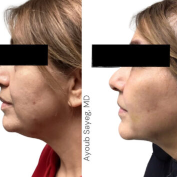 HD LipoX® of Jawline at Face Works Plastic Surgery, Plastic Surgeon Near Me in Schaumburg, IL
