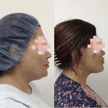 HD LipoX® of Jawline at Face Works Plastic Surgery, Plastic Surgeon Near Me in Schaumburg, IL