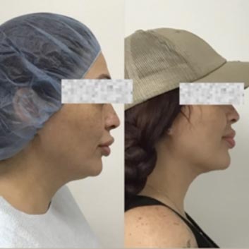 HD LipoX® of Jawline at Face Works Plastic Surgery, Plastic Surgeon Near Me in Schaumburg, IL