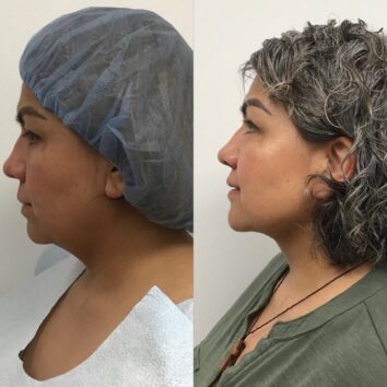 HD LipoX® of Jawline at Face Works Plastic Surgery, Plastic Surgeon Near Me in Schaumburg, IL