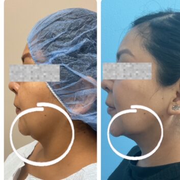 HD LipoX® of Jawline at Face Works Plastic Surgery, Plastic Surgeon Near Me in Schaumburg, IL