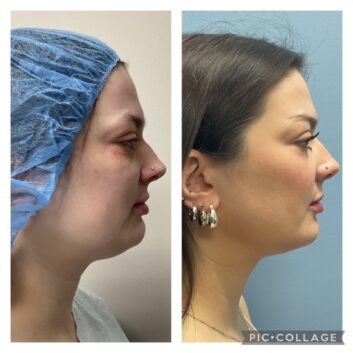 HD LipoX® of Jawline at Face Works Plastic Surgery, Plastic Surgeon Near Me in Schaumburg, IL HD LipoX® of Jawline at Face Works Plastic Surgery, Plastic Surgeon Near Me in Schaumburg, IL
