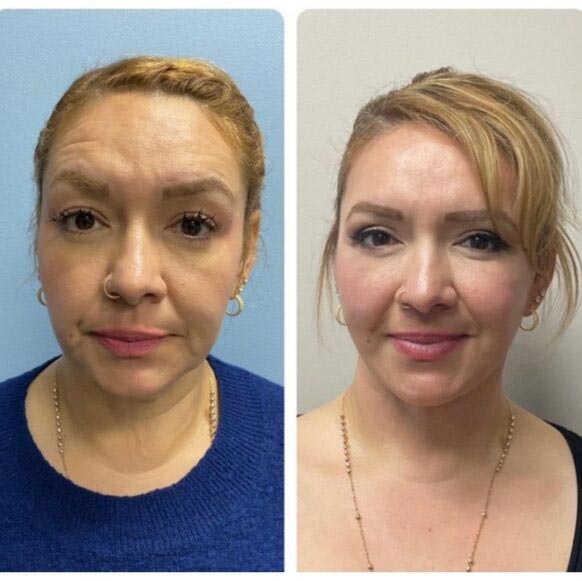 Face Lift at Face Works Plastic Surgery, Plastic Surgeon Near Me in Schaumburg, IL