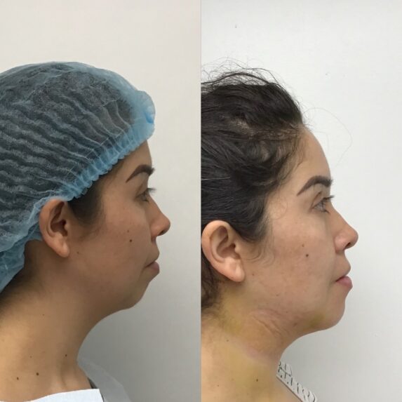 Facial/Chin Implants at Face Works Plastic Surgery, Plastic Surgeon Near Me in Schaumburg, IL