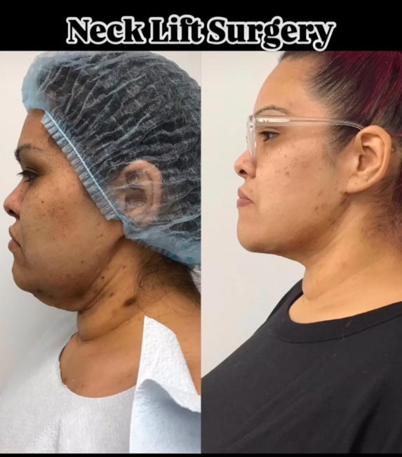Neck Lift at Face Works Plastic Surgery, Plastic Surgeon Near Me in Schaumburg, IL
