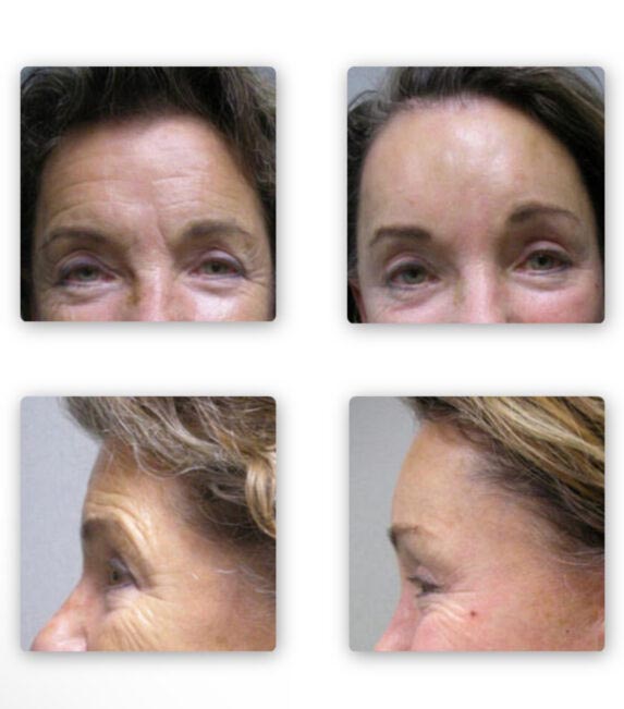 Endoscopic Brow Lift at Face Works Plastic Surgery, Plastic Surgeon Near Me in Schaumburg, IL