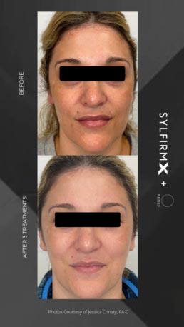 RF + Micro-needling at Face Works Plastic Surgery, Plastic Surgeon Near Me in Schaumburg, IL