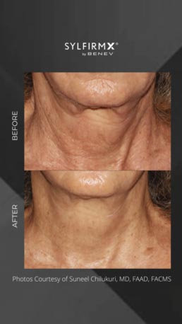 RF + Micro-needling at Face Works Plastic Surgery, Plastic Surgeon Near Me in Schaumburg, IL