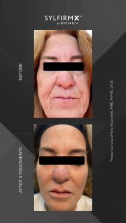 RF + Micro-needling at Face Works Plastic Surgery, Plastic Surgeon Near Me in Schaumburg, IL