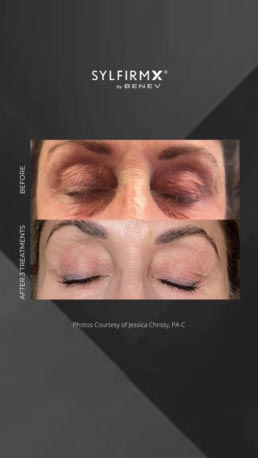 RF + Micro-needling at Face Works Plastic Surgery, Plastic Surgeon Near Me in Schaumburg, IL