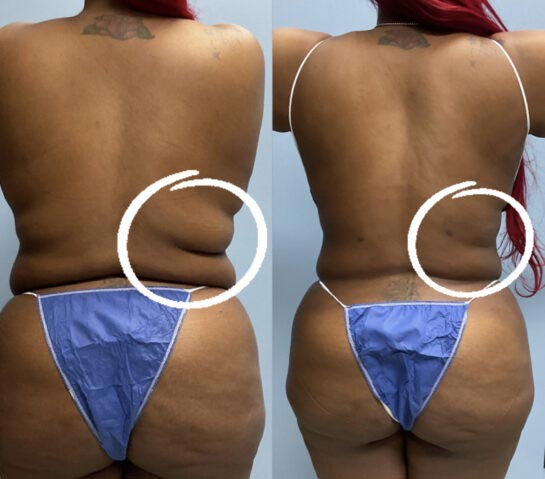 Body Liposuction at Face Works Plastic Surgery, Plastic Surgeon Near Me in Schaumburg, IL