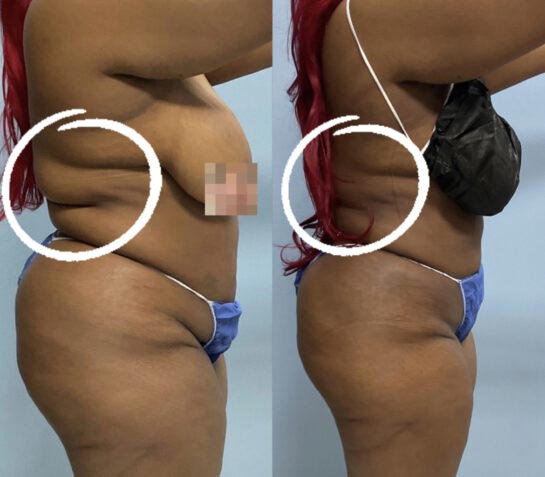 Body Liposuction at Face Works Plastic Surgery, Plastic Surgeon Near Me in Schaumburg, IL