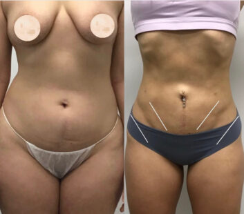 Body Liposuction at Face Works Plastic Surgery, Plastic Surgeon Near Me in Schaumburg, IL