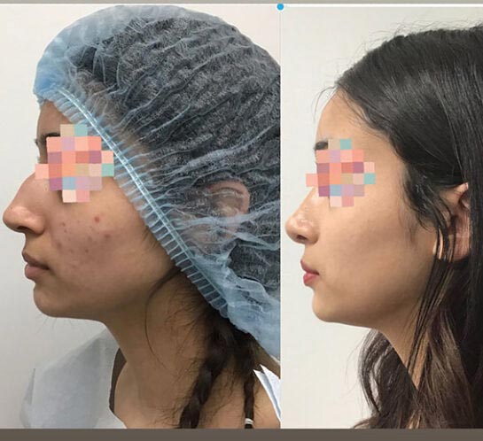 Nose Plastic Surgery at Face Works Plastic Surgery, Plastic Surgeon Near Me in Schaumburg, IL