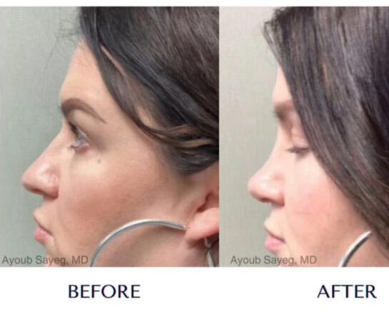 Nose Plastic Surgery at Face Works Plastic Surgery, Plastic Surgeon Near Me in Schaumburg, IL