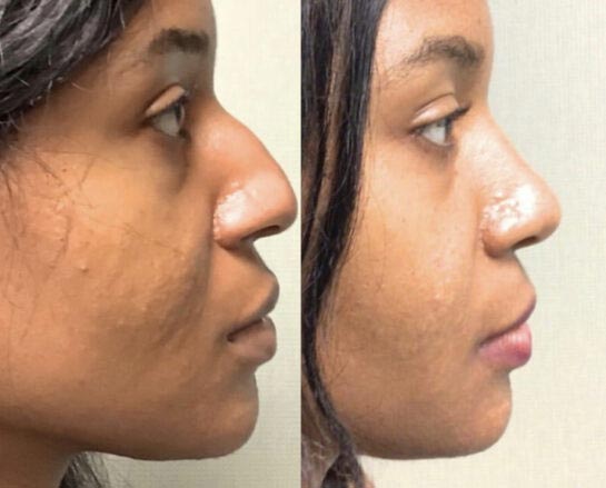 Nose Plastic Surgery at Face Works Plastic Surgery, Plastic Surgeon Near Me in Schaumburg, IL