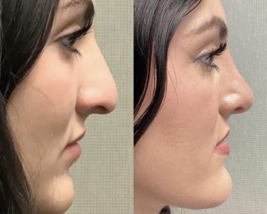 Nose Plastic Surgery at Face Works Plastic Surgery, Plastic Surgeon Near Me in Schaumburg, IL