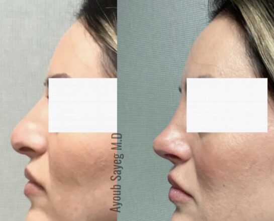 Nose Plastic Surgery at Face Works Plastic Surgery, Plastic Surgeon Near Me in Schaumburg, IL