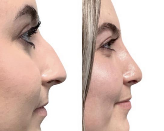 Nose Plastic Surgery at Face Works Plastic Surgery, Plastic Surgeon Near Me in Schaumburg, IL