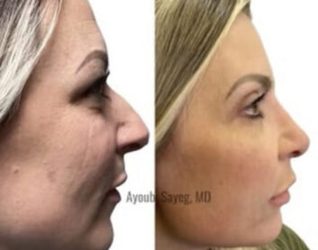 Nose Plastic Surgery at Face Works Plastic Surgery, Plastic Surgeon Near Me in Schaumburg, IL