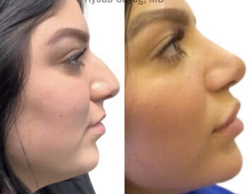 Nose Plastic Surgery at Face Works Plastic Surgery, Plastic Surgeon Near Me in Schaumburg, IL
