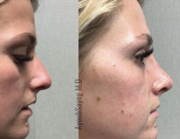 Nose Plastic Surgery at Face Works Plastic Surgery, Plastic Surgeon Near Me in Schaumburg, IL