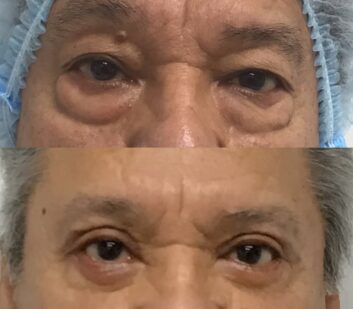 Eyelids Plastic Surgery at Face Works Plastic Surgery, Plastic Surgeon Near Me in Schaumburg, IL