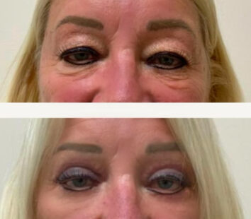 Eyelids Plastic Surgery at Face Works Plastic Surgery, Plastic Surgeon Near Me in Schaumburg, IL