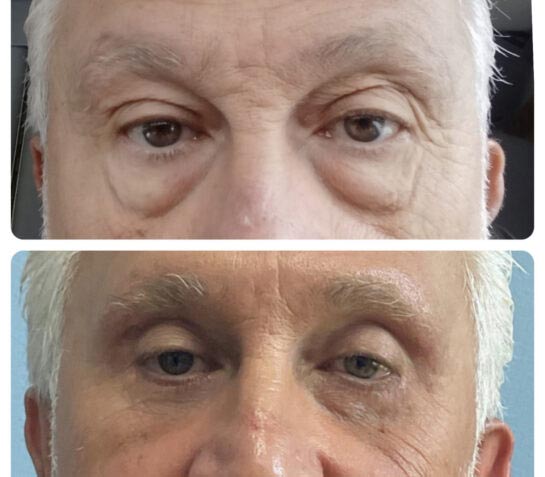 Eyelids Plastic Surgery at Face Works Plastic Surgery, Plastic Surgeon Near Me in Schaumburg, IL