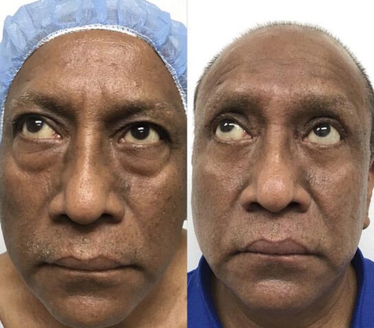 Eyelids Plastic Surgery at Face Works Plastic Surgery, Plastic Surgeon Near Me in Schaumburg, IL