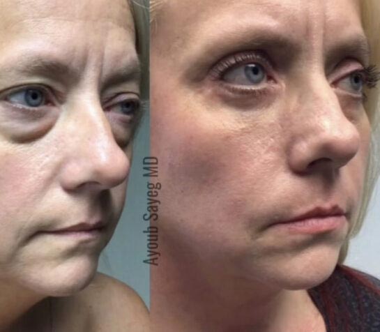 Eyelids Plastic Surgery at Face Works Plastic Surgery, Plastic Surgeon Near Me in Schaumburg, IL