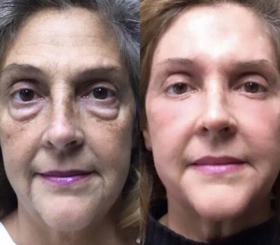Eyelids Plastic Surgery at Face Works Plastic Surgery, Plastic Surgeon Near Me in Schaumburg, IL