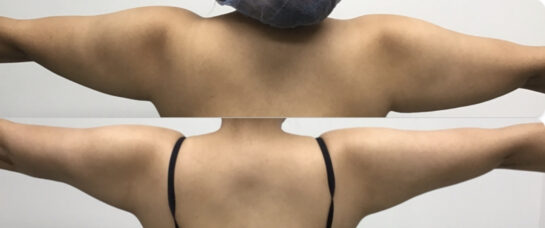 Arms Plastic Surgery at Face Works Plastic Surgery, Plastic Surgeon Near Me in Schaumburg, IL Arms Plastic Surgery at Face Works Plastic Surgery, Plastic Surgeon Near Me in Schaumburg, IL