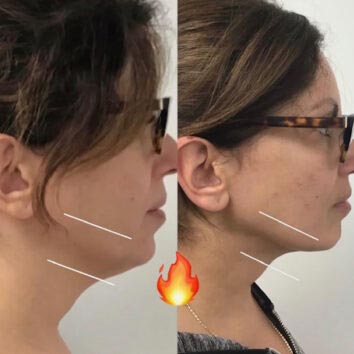 HD LipoX® of Jawline at Face Works Plastic Surgery, Plastic Surgeon Near Me in Schaumburg, IL