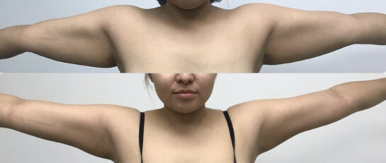 Arms Plastic Surgery at Face Works Plastic Surgery, Plastic Surgeon Near Me in Schaumburg, IL Arms Plastic Surgery at Face Works Plastic Surgery, Plastic Surgeon Near Me in Schaumburg, IL